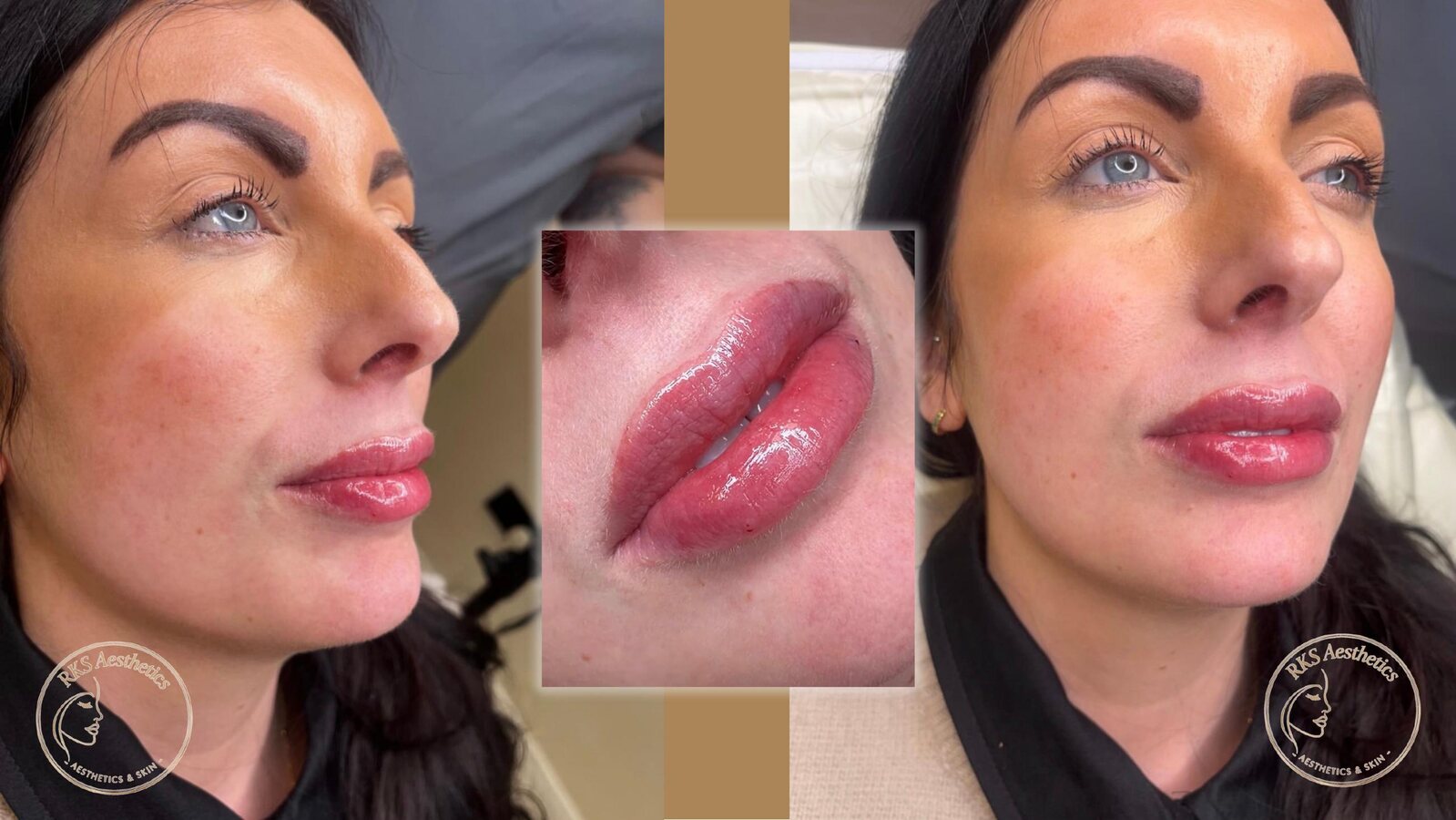Lip Harmonisation — RKS Aesthetics treatment layout