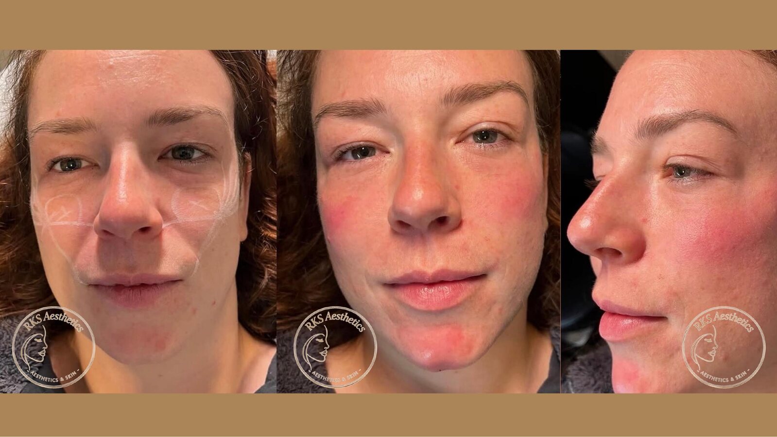 Skin Rejuvenation — RKS Aesthetics treatment layout